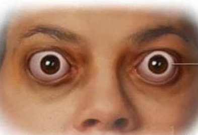 甲亢突眼